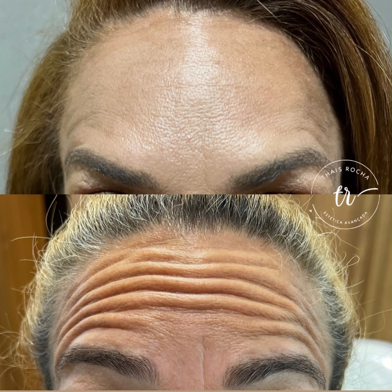 Botox Facial — foto 1