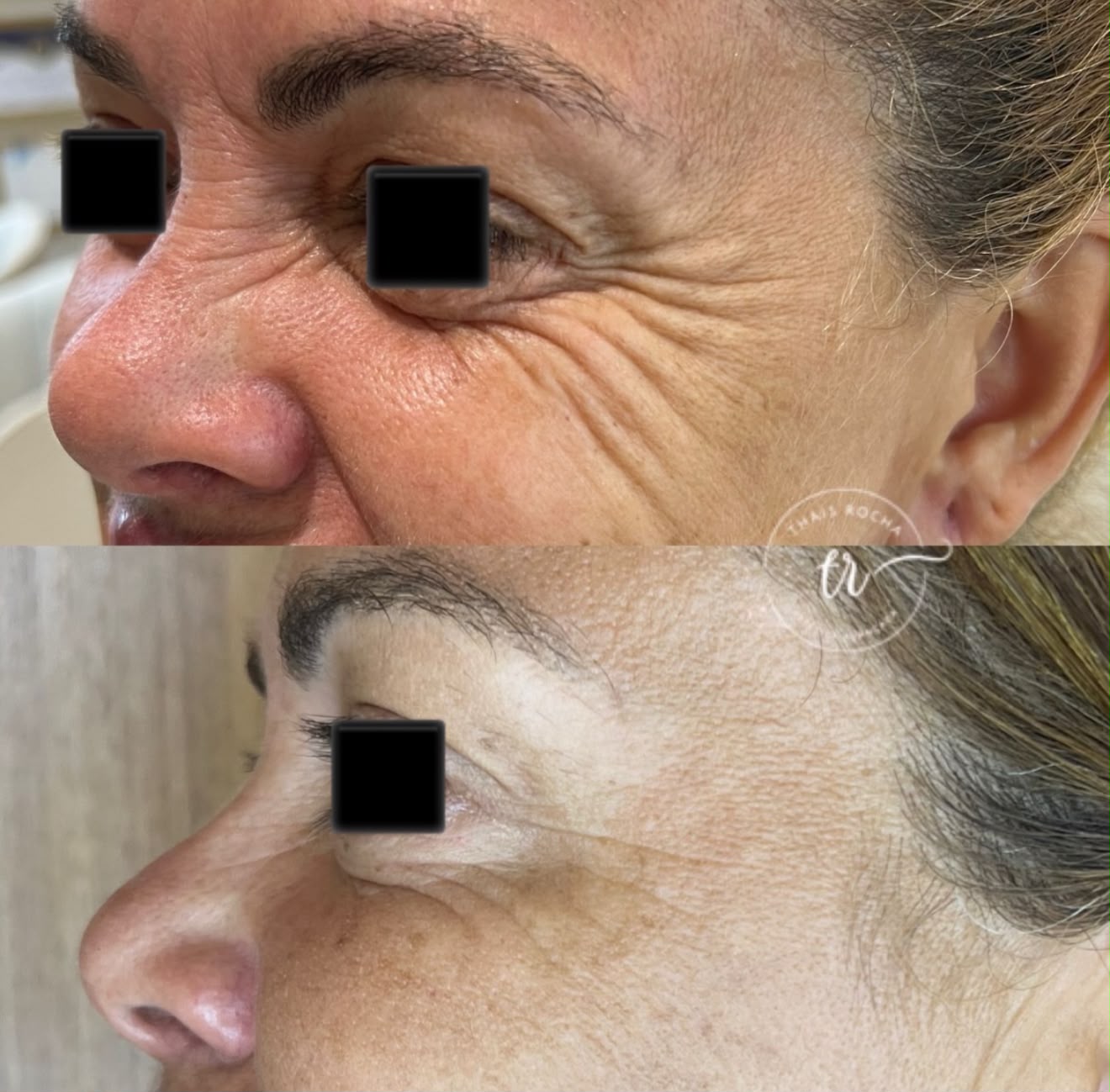 Botox Facial — foto 4