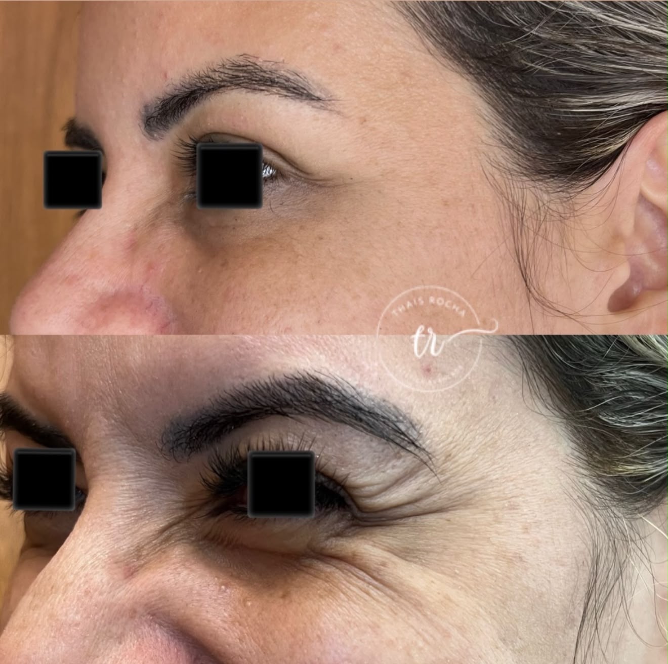 Botox Facial — foto 6