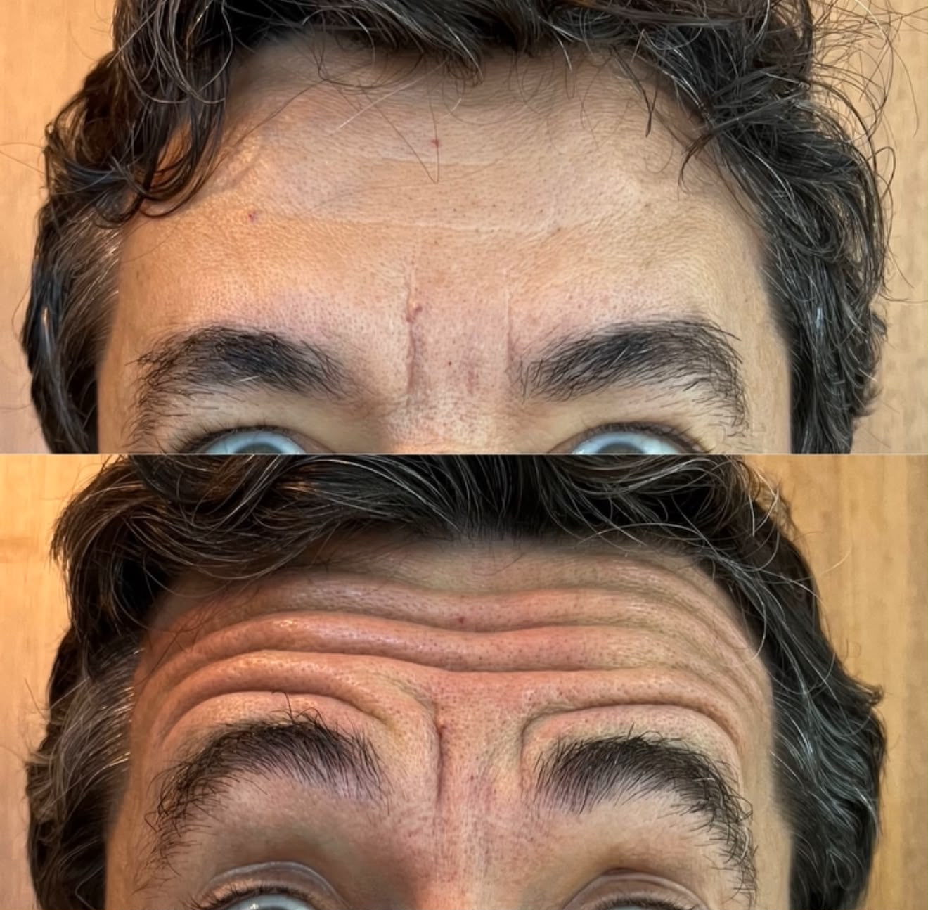 Botox Facial — foto 8