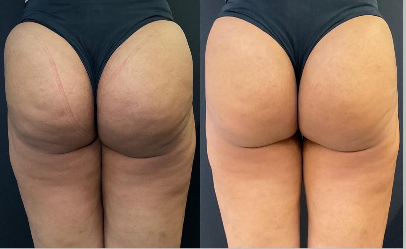Emagrecimento & Bioestimulador de Glúteos — foto 1