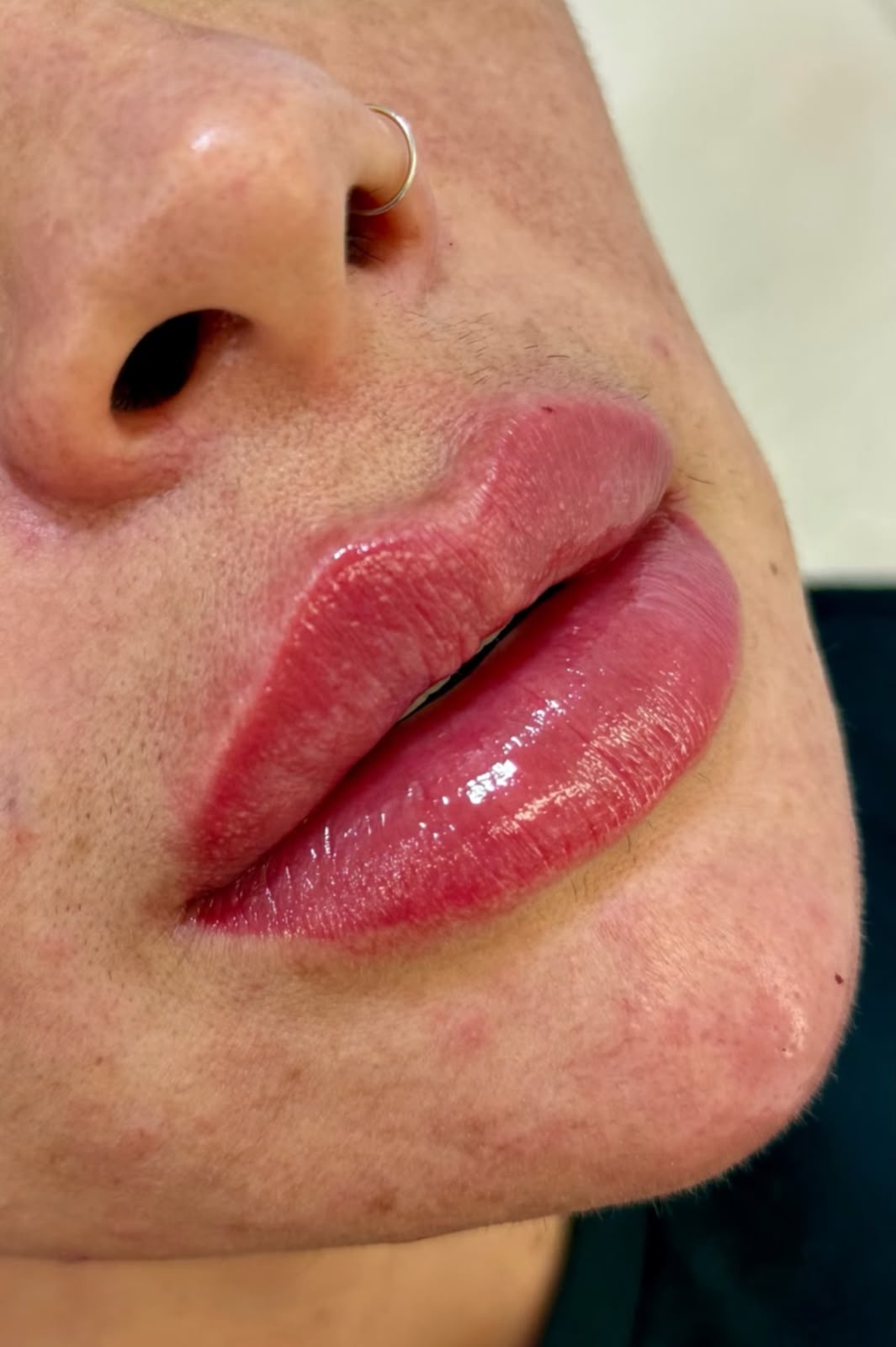 Preenchimento Labial — foto 2