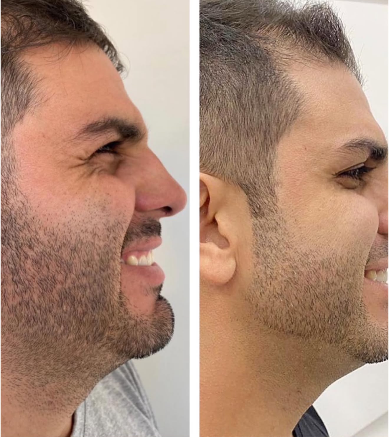 Lipo de Papada sem Cortes — foto 2