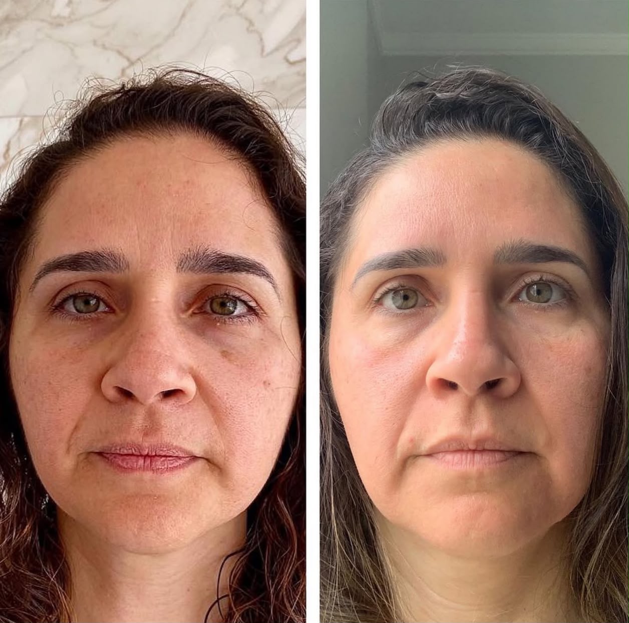 Peeling & Clareamento — foto 1