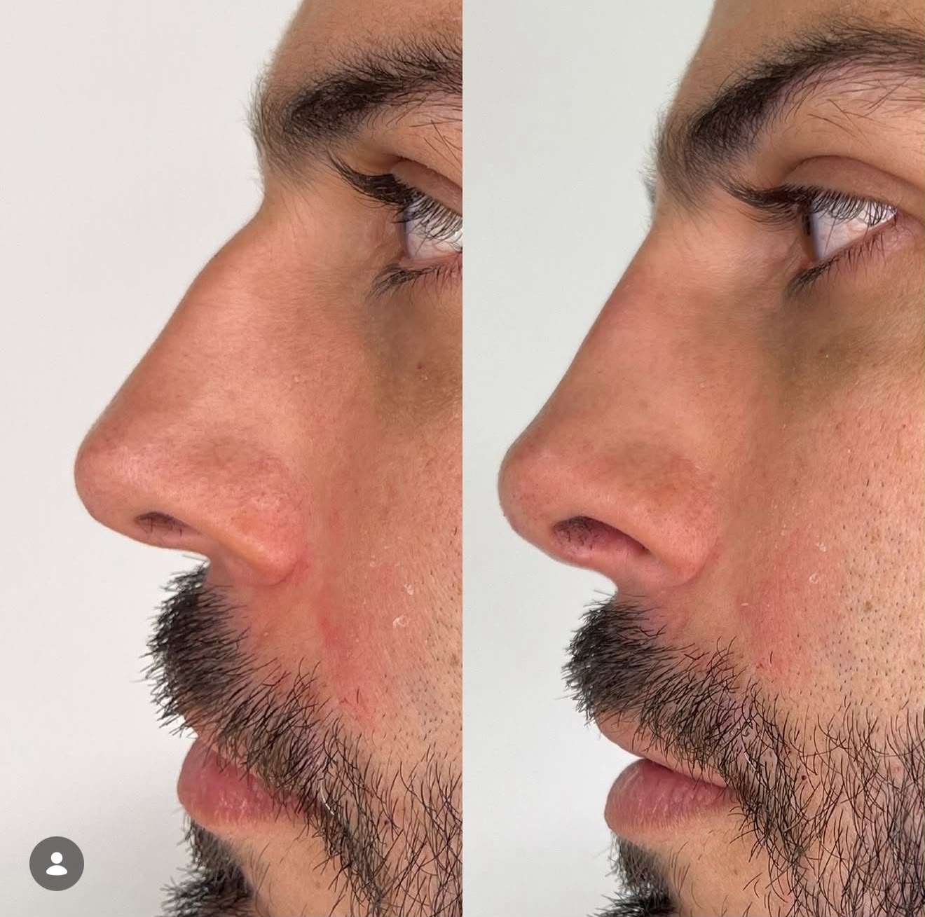 Rinomodelação — foto 5